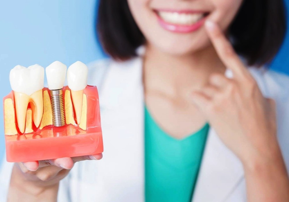 Имплантация зубов на 4 имплантах: все, что вам нужно знать