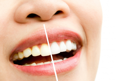 Особенности и виды отбеливания зубов